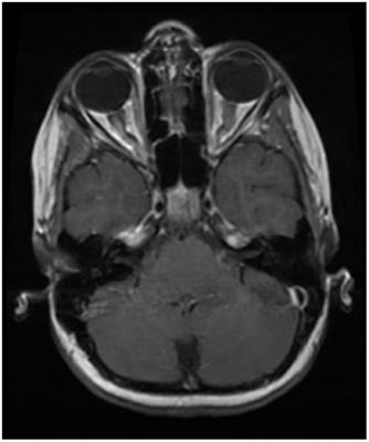 Pathophysiology of myelin oligodendrocyte glycoprotein antibody disease